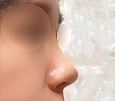 Phẫu thuật hơn filler bbb