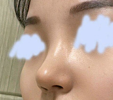Review một tháng sau phẫu thuật mũi ^^