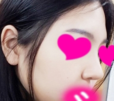 Từ mũi như bí đỏ thành mũi như dưa leo lol