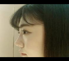 Filler mũi quá đỉnh