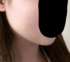 I think the contour injection went well!