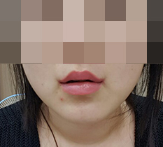 Tôi đã làm phẫu thuật khóe miệng~~