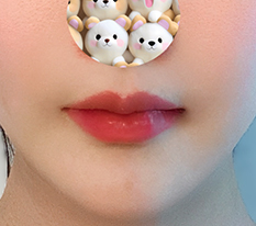Phẫu thuật đường Cupid không để lại sẹo