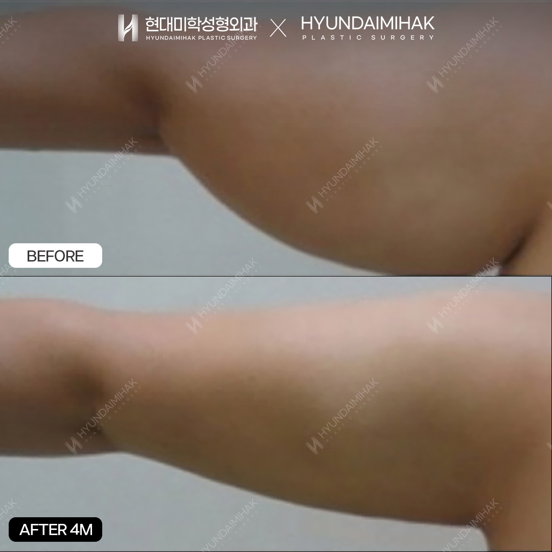 Hút mỡ bắp tay sau 4 tháng