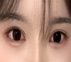 Mình đã có đôi mắt nổi bật nhờ cắt mí + mở góc mắt toàn diện