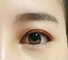 Đã một tuần kể từ khi phẫu thuật mắt lần hai^^