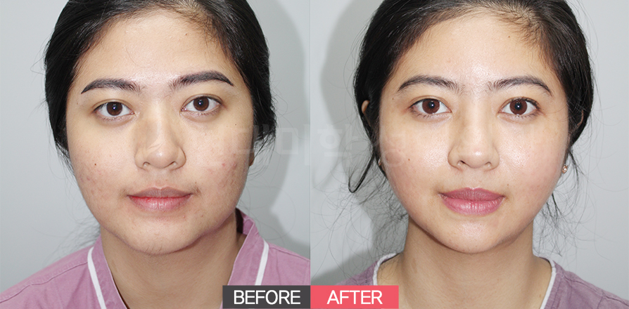 Cấy mỡ (má, thái dương, trán) + cắt mí dưới + loại bỏ mỡ má sâu + Venus nọng cằm + căng chỉ