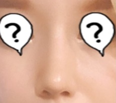 My unattractive nose changed my whole image after rhinoplasty at Thẩm mỹ Hyundai!