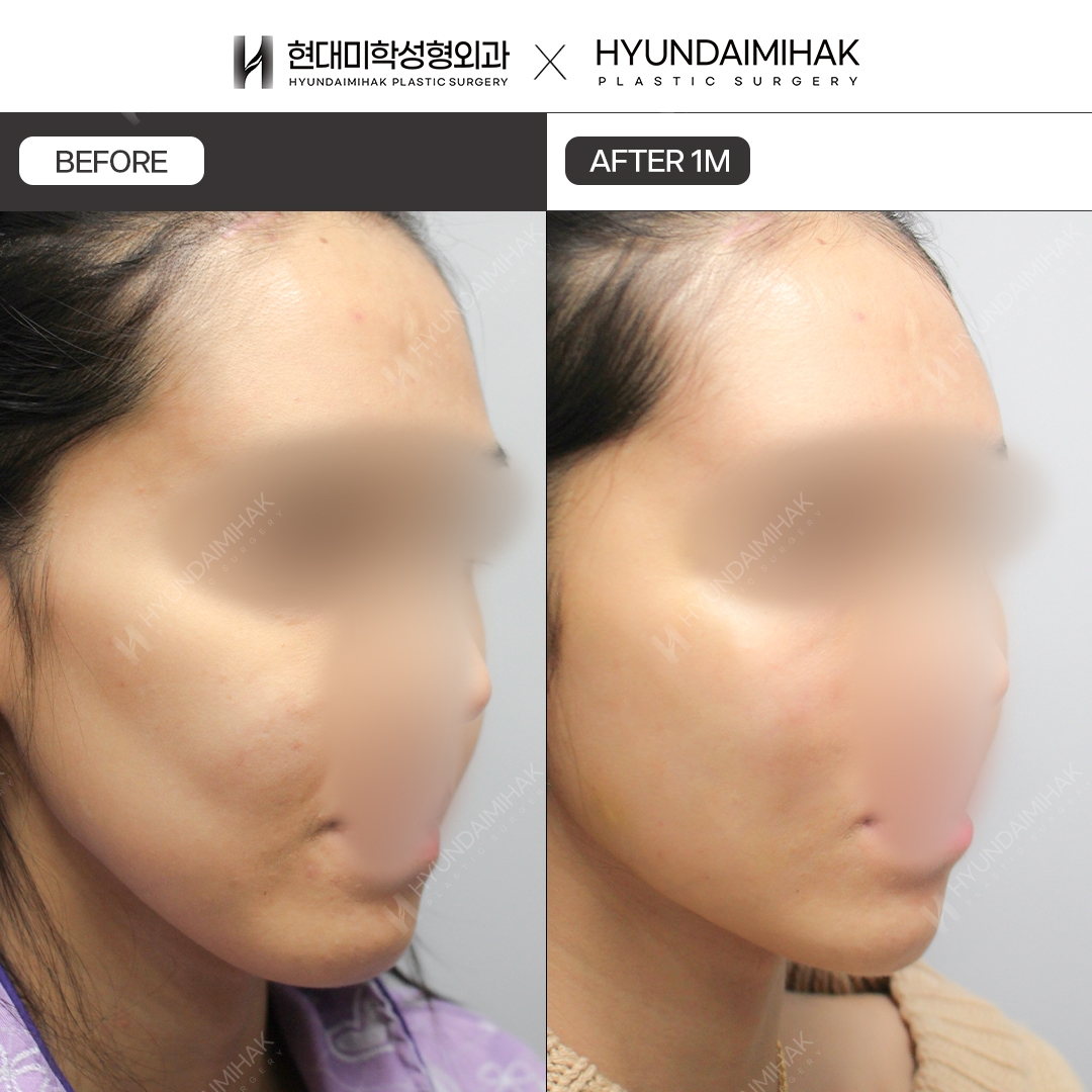 [Phẫu thuật trẻ hóa] Căng chỉ sau 1 tháng