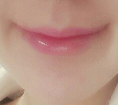 Mouth corners + fat grafting review ♡