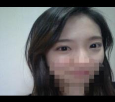 Review cắt mí và mở góc mắt trong.. giờ mới viết nè haha