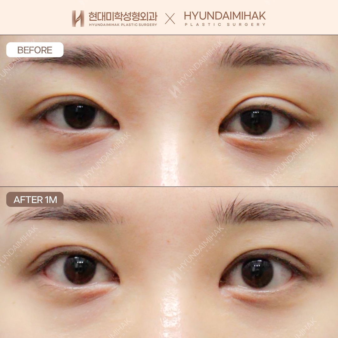 [Tái phẫu thuật mắt] Cắt mí + Chỉnh cơ nâng mi