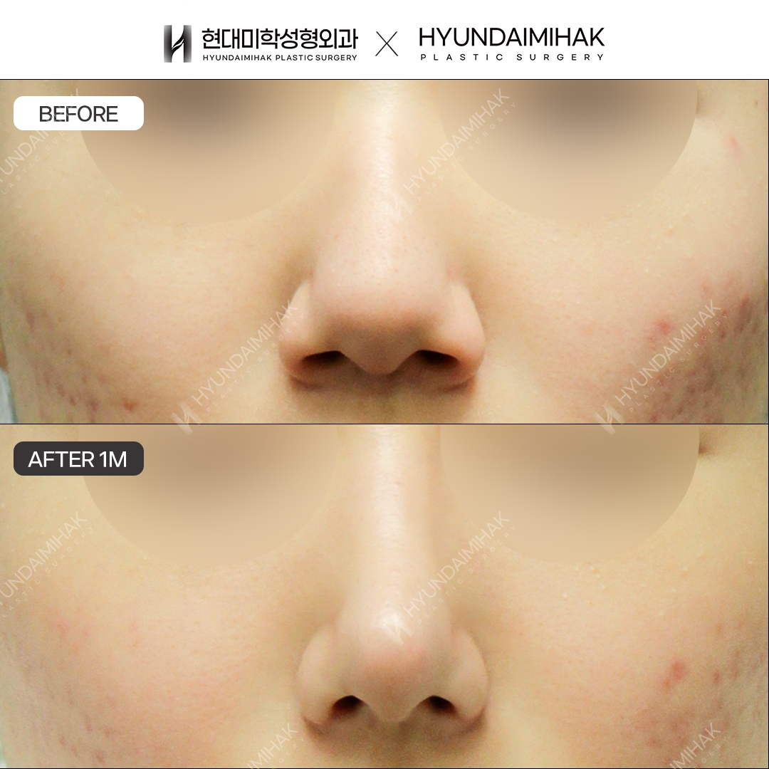 [Chỉnh mũi gồ] Sống mũi + đầu mũi, sau 1 tháng