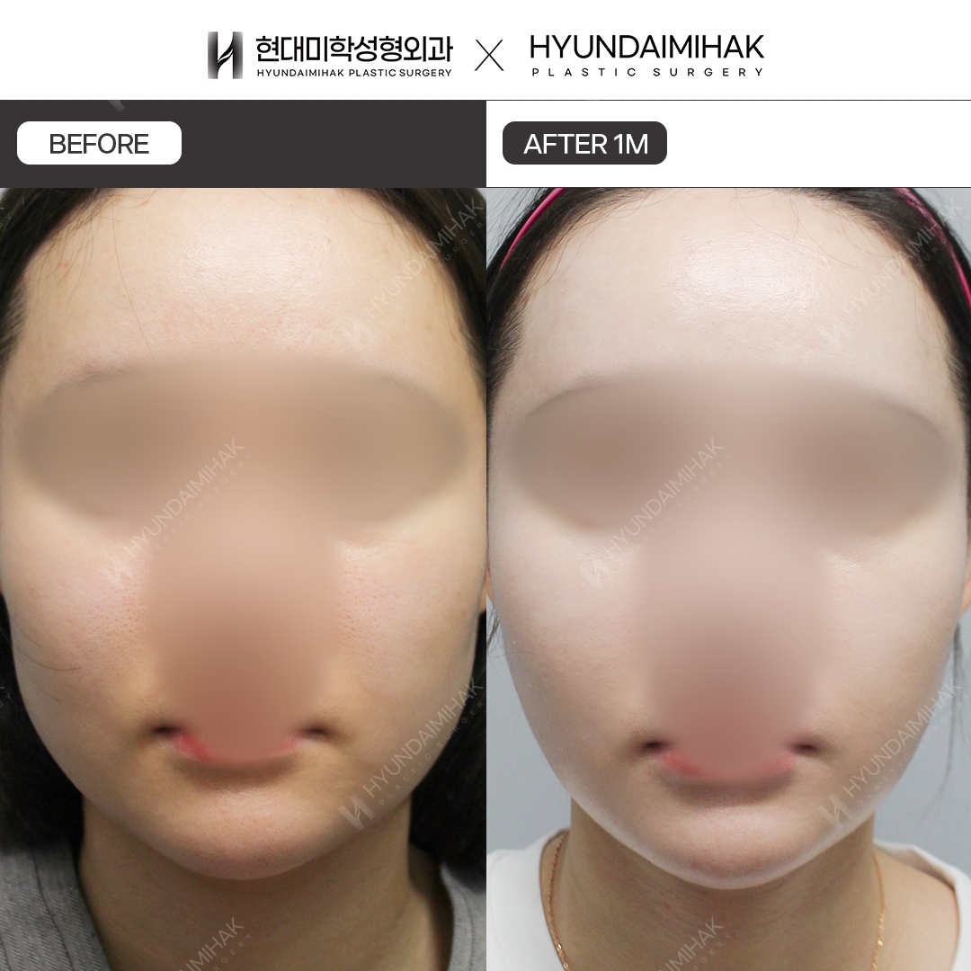 [Nâng cơ] Căng chỉ vùng nọng cằm sau 1 tháng