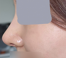 Chiếc mũi thay đổi hẳn chỉ sau một tháng