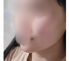 Hút mỡ mặt + Nâng chỉ!!