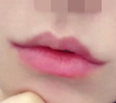 Tự tin tăng vọt nhờ phẫu thuật nâng khóe miệng ㅋㅋ