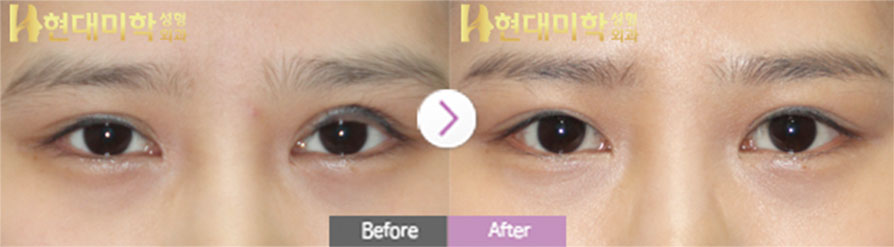 Tái phẫu thuật mắt rạch, chỉnh cơ nâng mi