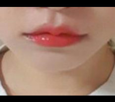 Phẫu thuật nâng góc miệng Cupid~>3<♡
