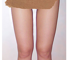 Hút mỡ đùi — đánh giá