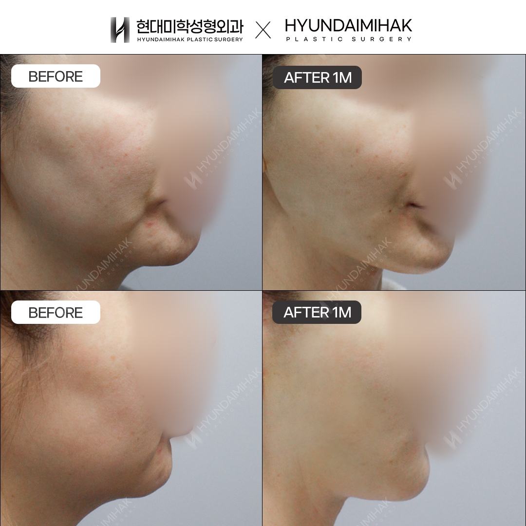 [Phẫu thuật trẻ hóa] Căng chỉ sau 1 tháng