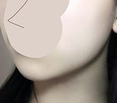 Dọn gọn mỡ cằm xong