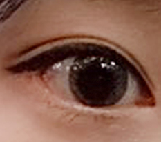 Canthoplasty is so good