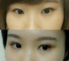 Tại sao bây giờ mới làm phẫu thuật mắt chứ ㅋㅋ