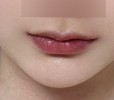 May mà đã làm phẫu thuật nâng góc môi haha