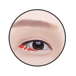 Hạ mí dưới bước 2 — rạch kết mạc rồi cố định vào màng xương