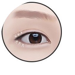 Mở đuôi mắt bước 4 - khâu cố định bằng chỉ tự tiêu