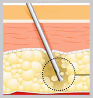 Đưa micro-cannula vào — hình cắt lớp tiêm vào lớp mỡ
