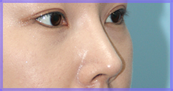 Sau phẫu thuật chỉnh mũi đầu chúi — ảnh nghiêng của mũi (AFTER)