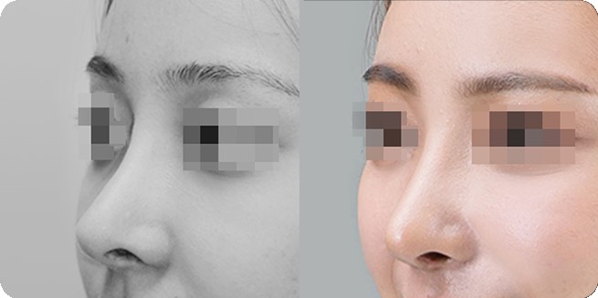 So sánh góc nghiêng trước và sau nâng mũi không vật liệu nhân tạo 1 (BEFORE / AFTER 3MONTH)