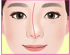 Minh họa mũi lệch dạng C