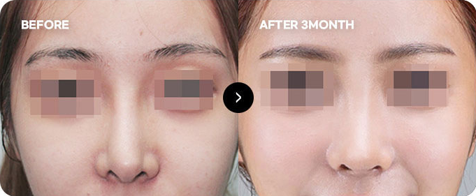 Trước và sau chỉnh sửa lại đường nét đầu mũi 4