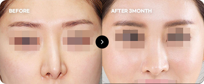 Trước và sau chỉnh sửa lại mũi bị lệch do phẫu thuật & dính da 1