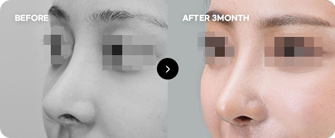 Trước và sau chỉnh sửa lại đường nét đầu mũi 3